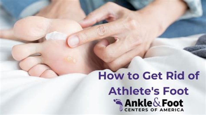 How Do You Get Rid Of Athlete’s Foot Fast