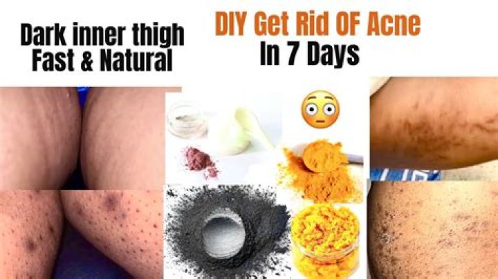 How To Clear Up Inner Thigh Acne
