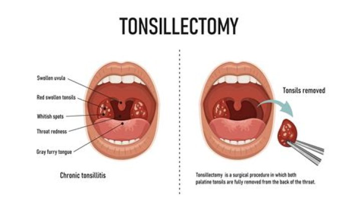 Question: Can Your Tonsils Grow Back After A Tonsillectomy Verywell Health