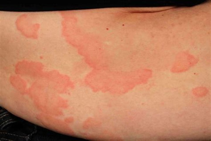 Question: Why Do I Have A Rash On My Buttcheek