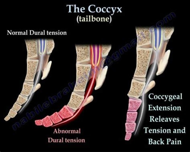 Quick Answer: How To Crack Your Coccyx