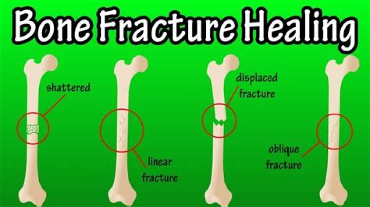 Why Do Old Broken Bones Hurt In The Cold
